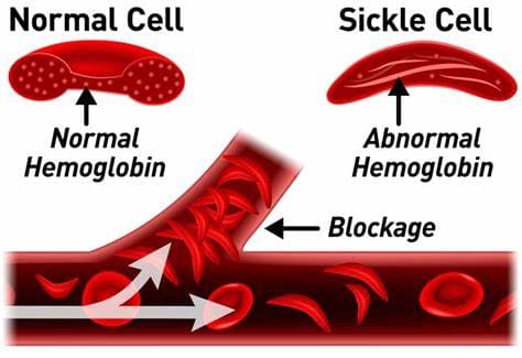 Acute Chest Syndrome: A Complication of the Sickle Cell Disease